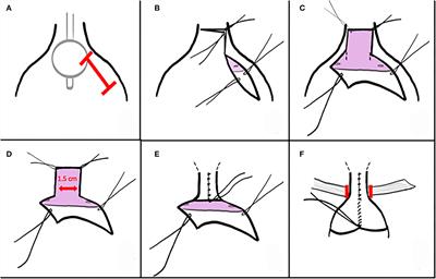 A fresh “slant” on modified Mitchell bladder neck reconstruction: A contemporary single-institution experience